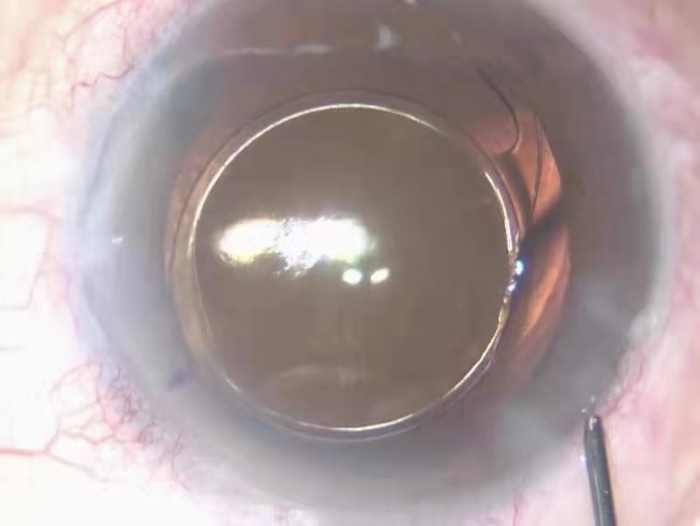 愛(ài)博諾德（北京）醫(yī)療科技有限公司+人工晶狀體(2)