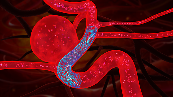 微創(chuàng)神通_血管重建裝置_圖片3