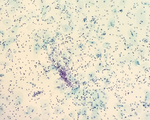 圖3 炎性反應(yīng)性改變細胞（霉菌感染）