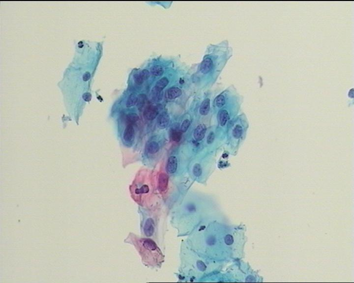 圖4 不能明確意義的非典型鱗狀上皮細胞（ASC-US）