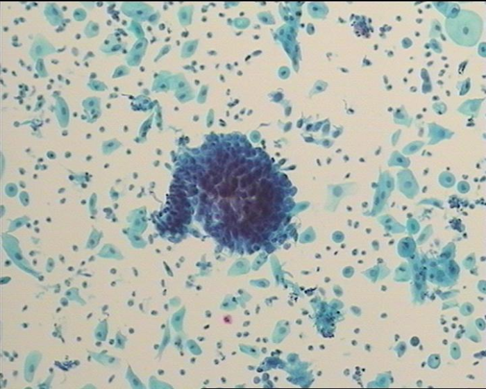 圖8 非典型腺細胞（AGC）