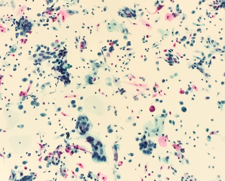 圖9 鱗狀細胞癌細胞（SCC）